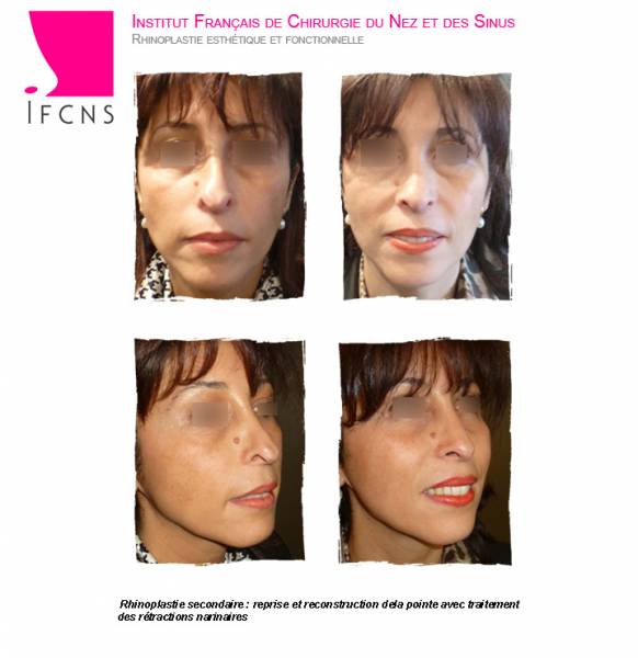 resultat avant apres rhinoplastie secondaire  pour asymetries de la pointe , strasbourg