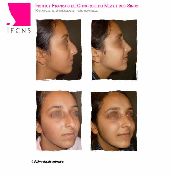 rhinoplastie chez une adolescente , resultat avant apres , Montpellier