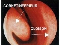 Réaliser une turbinoplastie/turbinectomie partielle  et une rhinoplastie pour améliorer les fonctions respiratoires, Rennes
