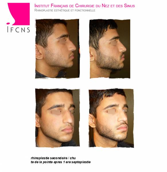 resultat rhinoplastie reussie marseille