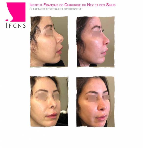 resultat avant apres rhinoplastie secondaire pour corbin et pointe ronde , Nancy