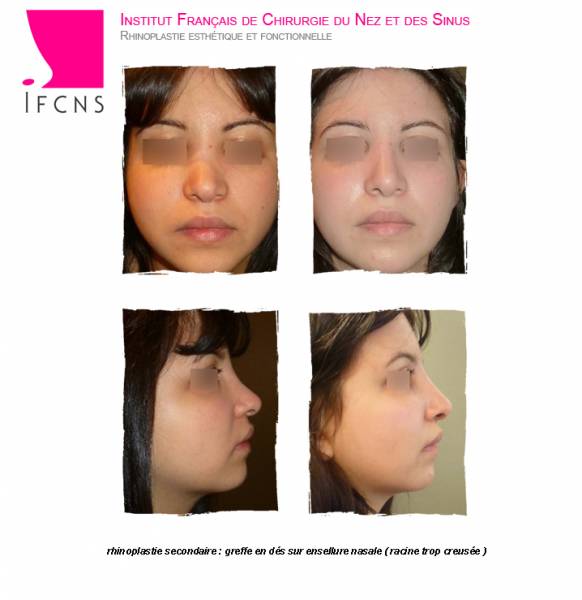 Résultat rhinoplastie secondaire pour réparer un aspect de  V inverse avec greffe de cartilage , Strasbourg