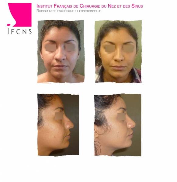 resultat rhinoplastie seondaire reussie Lille