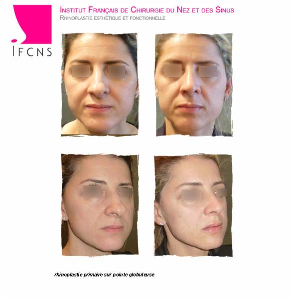 Rhinoplastie sur peau grasse et epaisse , résultat rhinoplastie avant après , Rennes
