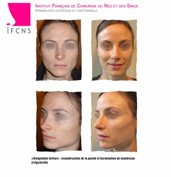 resultat avant apres rhinoplastie secondaire pour asymétries multiples de la pointe , Nice