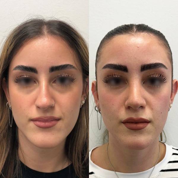 resultat rhinoplastie avant apres dr azan