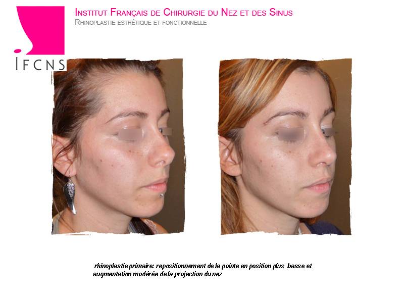 Enlever une bosse sur un nez a peau fine et obtenir un résultat naturel , rhinoplastie avant aprés , Montpellier