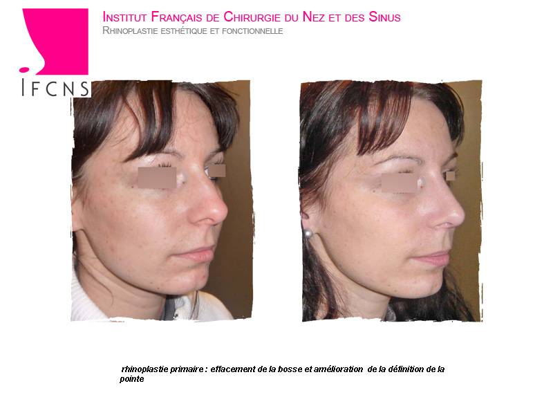 Affiner un nez large avec une rhinoplastie esthetique , résultat avant après , Nantes