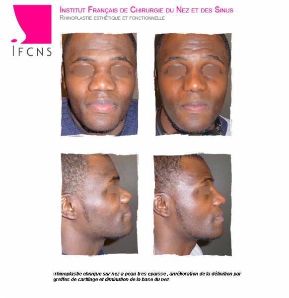 Résultat avant apres rhinoplastie ethnique de type Africain , Paris