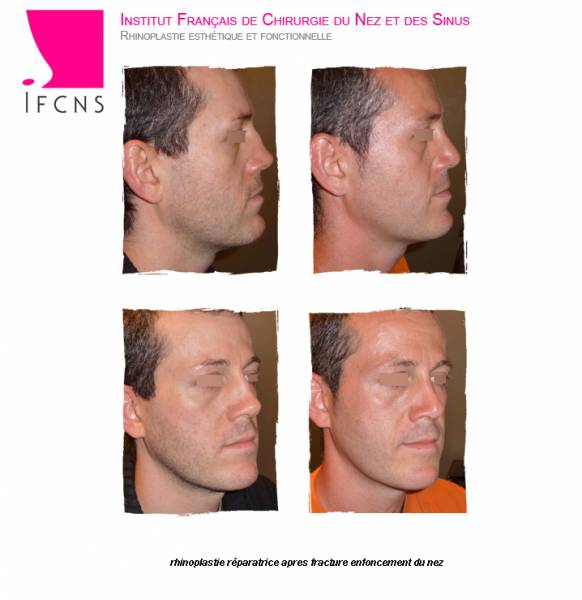 rhinoplaste avant apres fracture du nez rouen