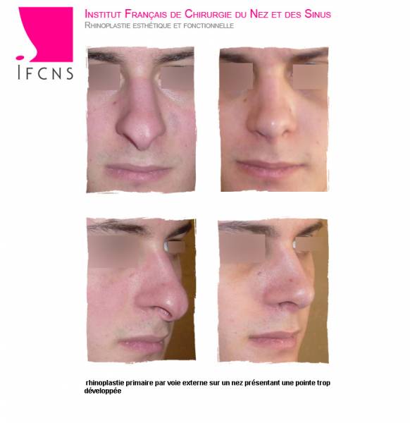 Affiner un nez disgracieux  avec une  pointe ronde , résultat avant avant après rhinoplastie , Lille