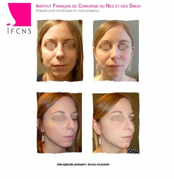 rhinoplastie chez une jeune femme pour affiner sa pointe , résultat avant après , Toulouse