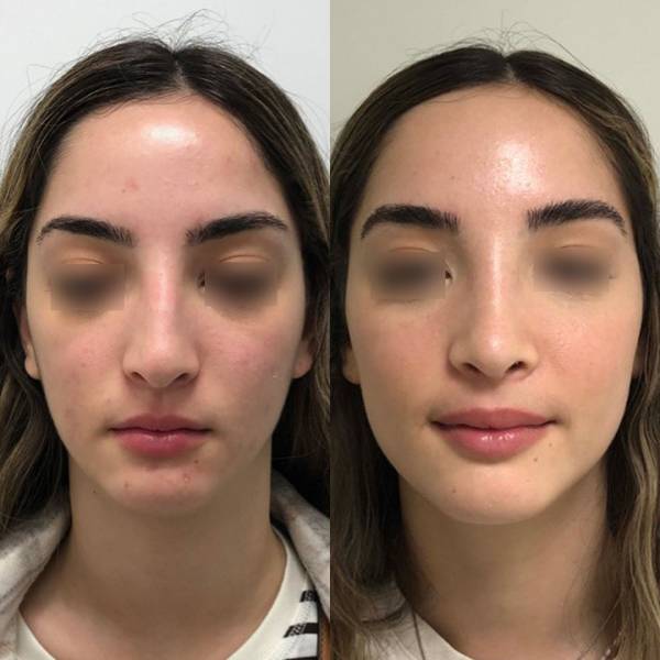rhinoplastie avant apres ultrasonique