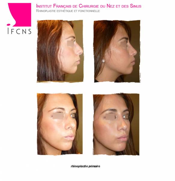 féminiser son nez , resultat avant apres rhinoplastie primaire , Strasbourg