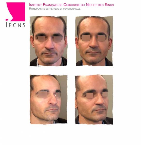 avant apres résultat rhinoplastie reims