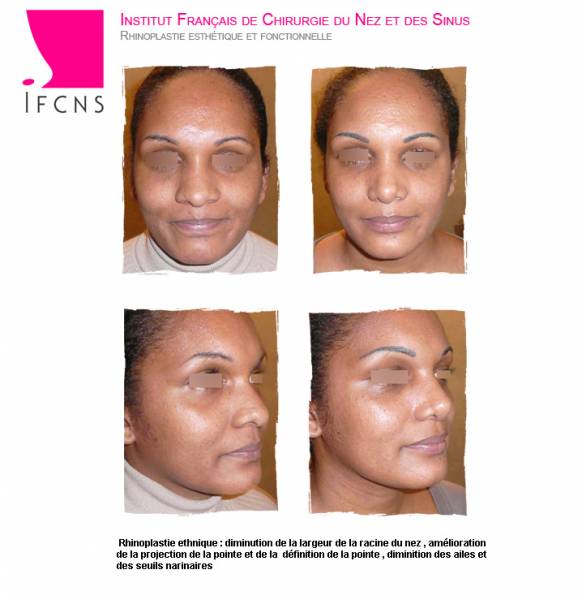 rhinoplastie ethnique resutat avant apres Lilles