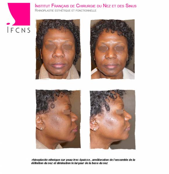 nez de type Africain avec peau épaisse , rhinoplastie ethnique resultat avant après , Nantes