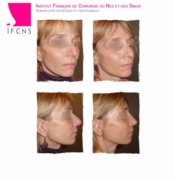 rhinoseptoplastie avant après Lyon