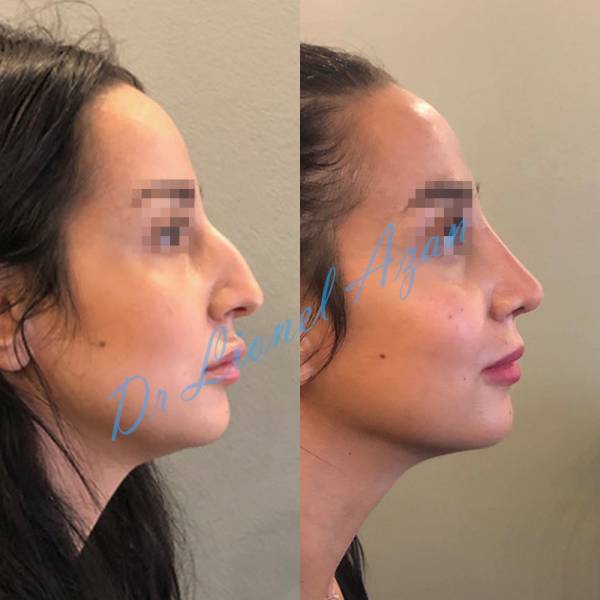 rhinoplastie ultrasonique paris