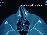 Réaliser une turbinoplastie/turbinectomie partielle  et une rhinoplastie pour améliorer les fonctions respiratoires, Rennes