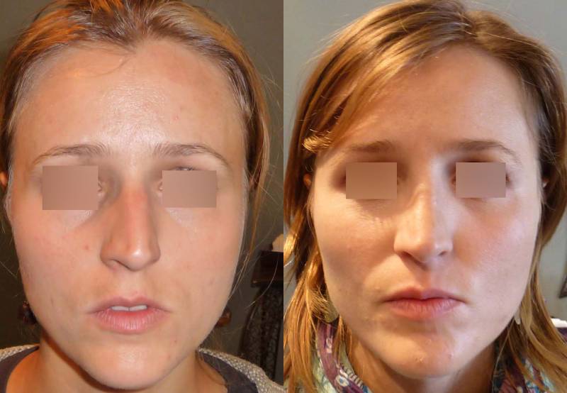 Améliorer sa respiration nasale avec une opération de rhinoseptoplastie, Marseille