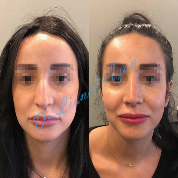 rhinoplastie reussie avant apres paris