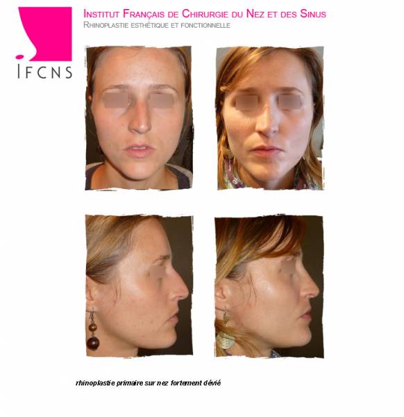 Résultat avant après rhinoseptoplastie pour un  nez dévie et une bosse , Nantes