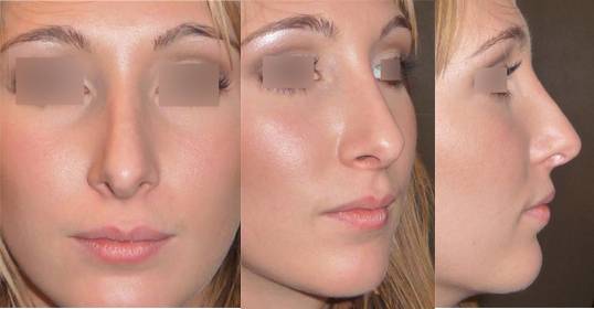 rhinoplastie resultat a 6 mois  marseille