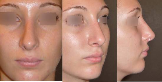 rhinoplastie resultat a 2 mois  Lyon
