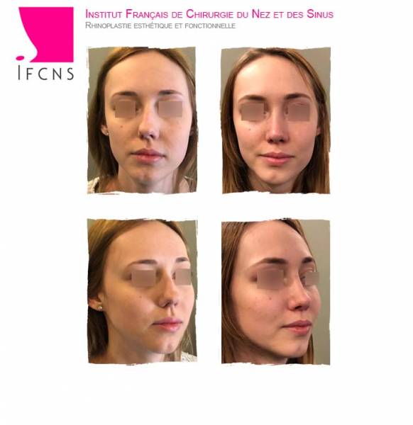 Rhinoplastie esthétique et fonctionnelle, Bordeaux 33000