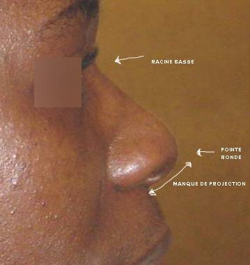 nez ethnique et greffe costale marseille