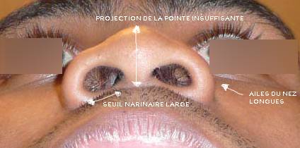 reduction des ailes narinaires nice