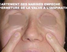 Comment solutionner des difficultés respiratoires avec une réparation de la valve nasale ? Genève, Suisse