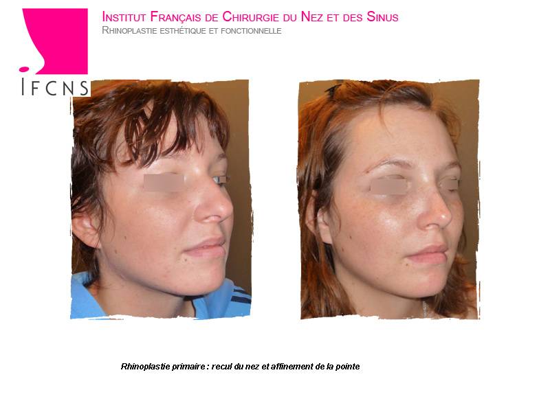 rhiniplastie avant apres rennes
