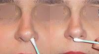soins pares rhinoplastie bordeaux