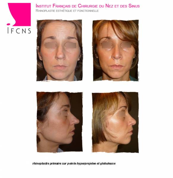 Raccourcir un nez trop long et affiner la pointe , résultat rhinoplastie esthétique avant après , Marseille
