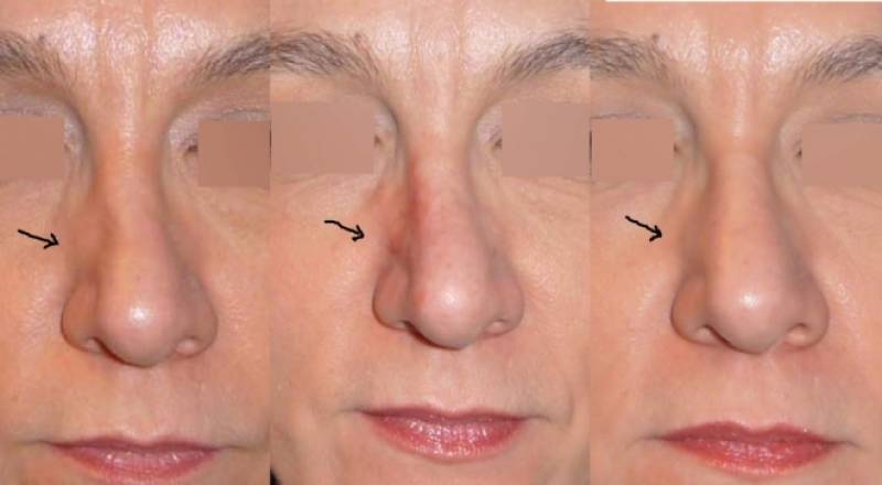 acide hyaluronique rhinoplastie Nantes