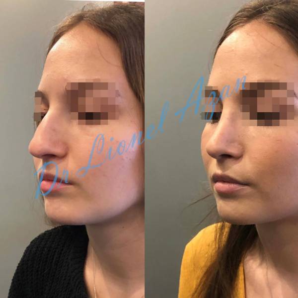 resultat rhinoplastie ultrasonique paris