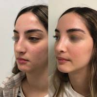 Dr Azan & Dr Susini -  Rhinoplastie secondaire après une opération du nez ratée