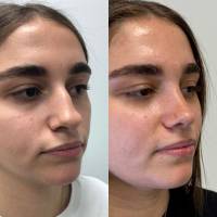 Dr Azan & Dr Susini -  Rhinoplastie ultrasonique pour la correction d'un nez cassé