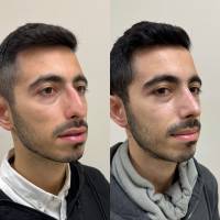 Dr Azan & Dr Susini -  Chirurgie en rhinoplastie ethnique pour un nez asiatique