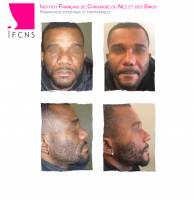 Dr Azan & Dr Susini -  Trouver un chirurgien pour réaliser une turbinoplastie