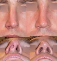 Institut de rhinoplastie à Bordeaux en Nouvelle-Aquitaine