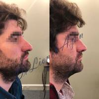 Institut de rhinoplastie à Paris en Île-de-France