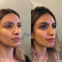 Institut de rhinoplastie à Genève en Suisse