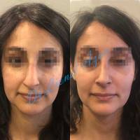 Dr Azan & Dr Susini -  Chirurgie en rhinoplastie ethnique pour un nez asiatique