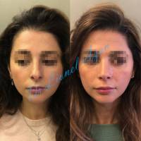 Dr Azan & Dr Susini -  Reconstruction d'un nez cassé par un chirurgien spécialisé
