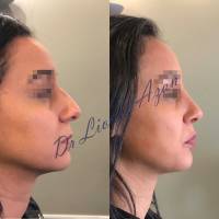 Dr Azan & Dr Susini -  Prix pour opérer un nez cassé