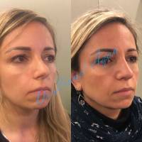 Dr Azan & Dr Susini -  Devis pour une rhinoseptoplastie par un chirurgien