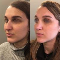 Institut de rhinoplastie à Marseille dans les Bouches-du-Rhône